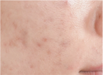 Tratamento para Cicatriz de Acne