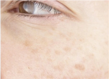 Tratamento para Melasma